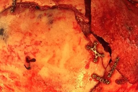 Cranial surgery.
